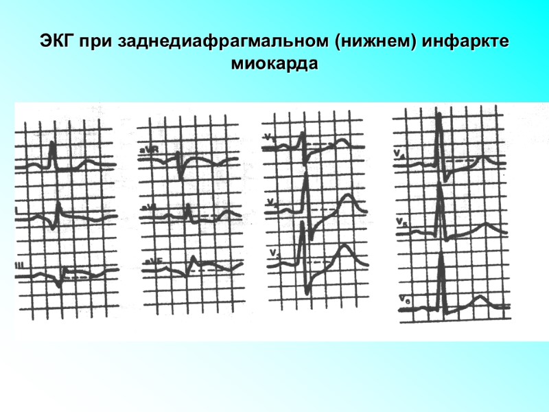 ЭКГ при заднедиафрагмальном (нижнем) инфаркте миокарда